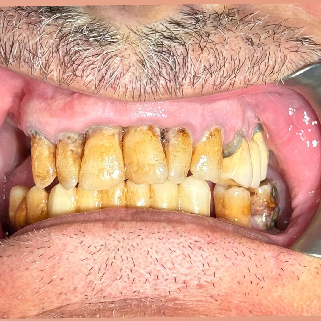 قبل — د. وهبي زرزور